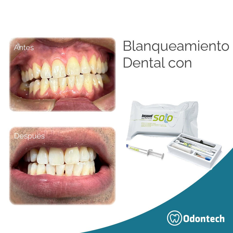 Blanqueamiento dental - One Solo - Dentopia Perú